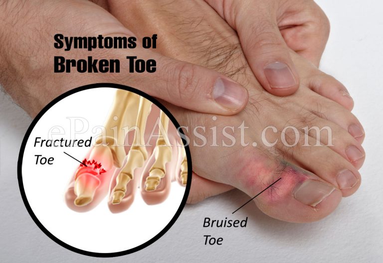 Broken Toe or Fractured Toe: Symptoms, Types, Treatment, Prognosis, Recovery