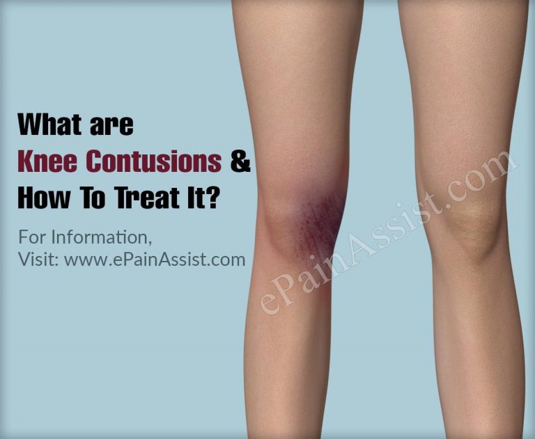 What are Knee Contusions and How To Treat It?