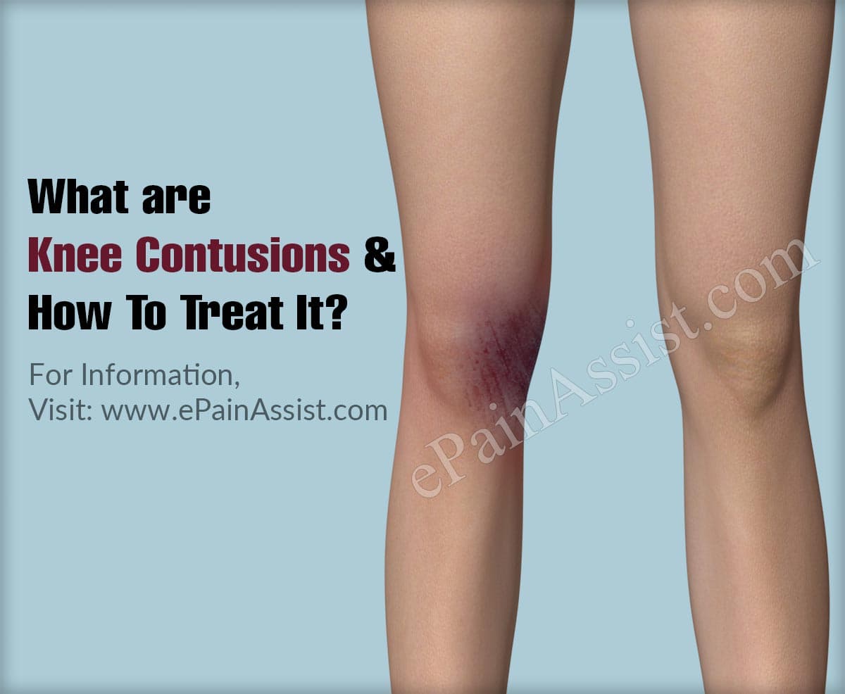 What are Knee Contusions and How To Treat It?