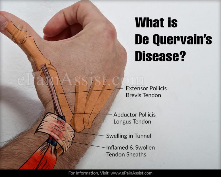 What is De Quervain’s Disease & How is it Treated?|Causes, Symptoms, Diagnosis of De Quervain’s Disease