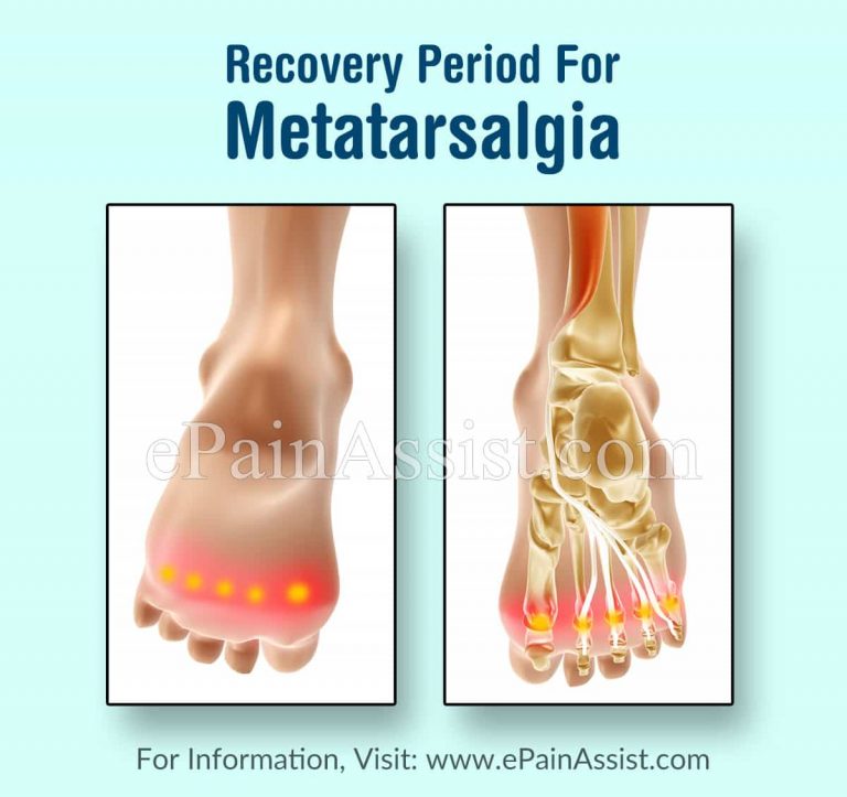 Recovery Period For Metatarsalgia