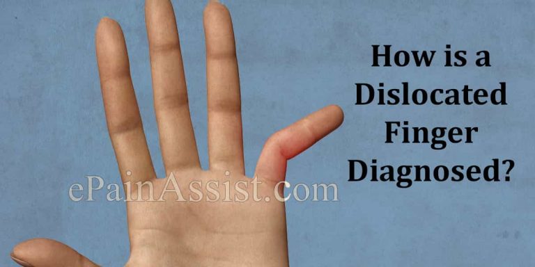 How is a Dislocated Finger Diagnosed & What is its Treatment, Recovery and Prognosis