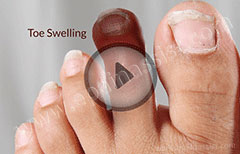 Swollen Toe: Treatment, Causes, Symptoms