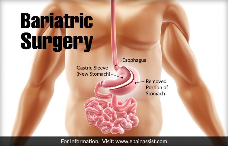 Bariatric Surgery: Indications, Patient Selection, Current Surgical Options, Possible Complications