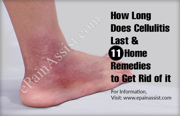 How Long Does Cellulitis Last & 11 Home Remedies to Get Rid of it
