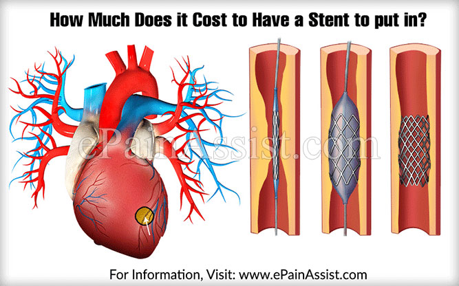 How Much Does it Cost to Have a Stent to Put in?