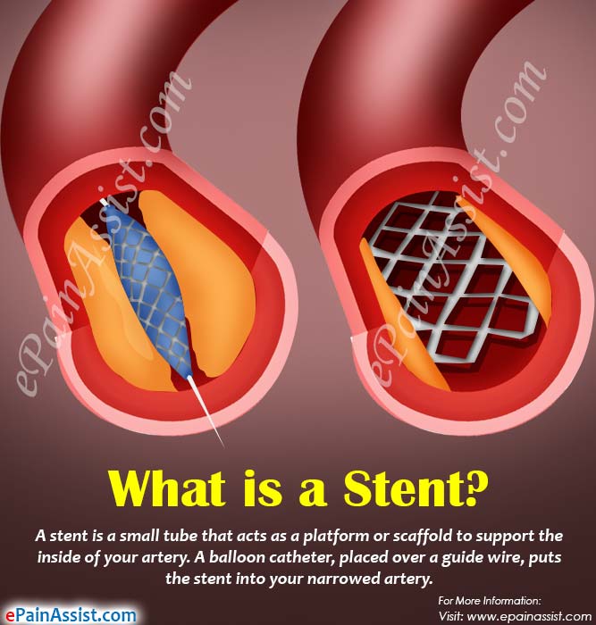 What is a Stent?