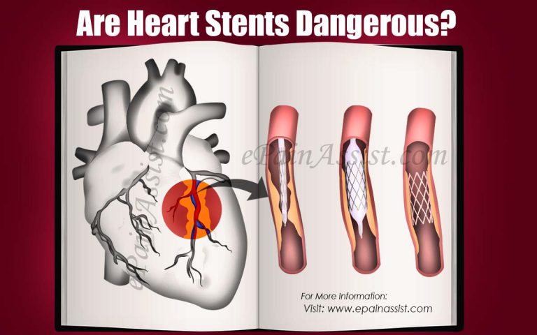 Are Heart Stents Dangerous?