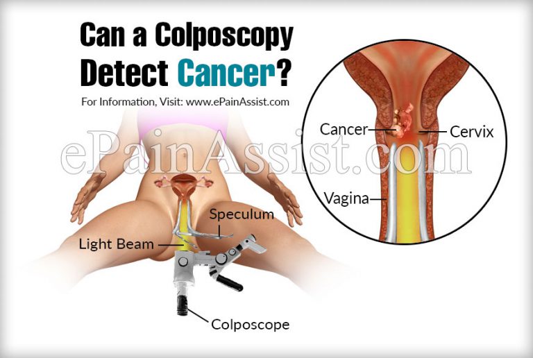 Can a Colposcopy Detect Cancer?