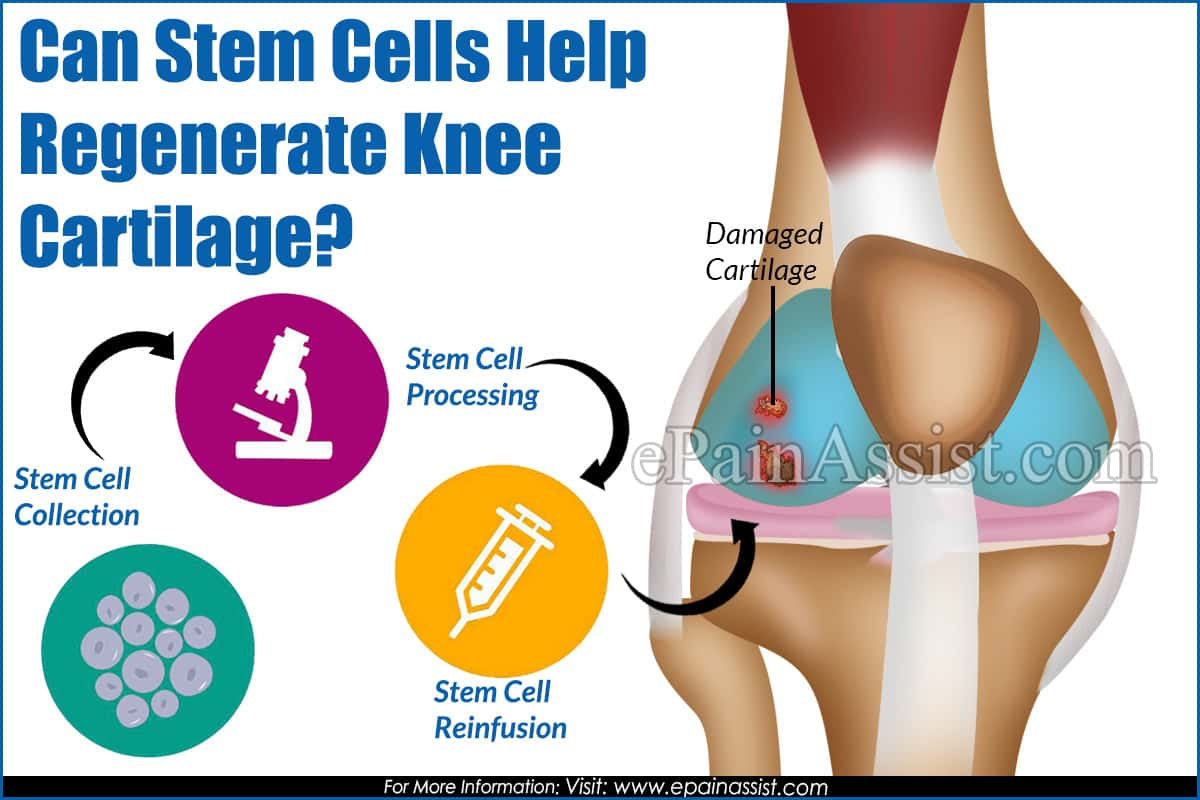 Can Stem Cells Help Regenerate Knee Cartilage?