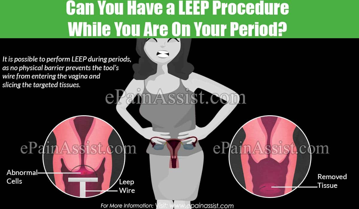 Can You Have a LEEP Procedure While You Are On Your Period?