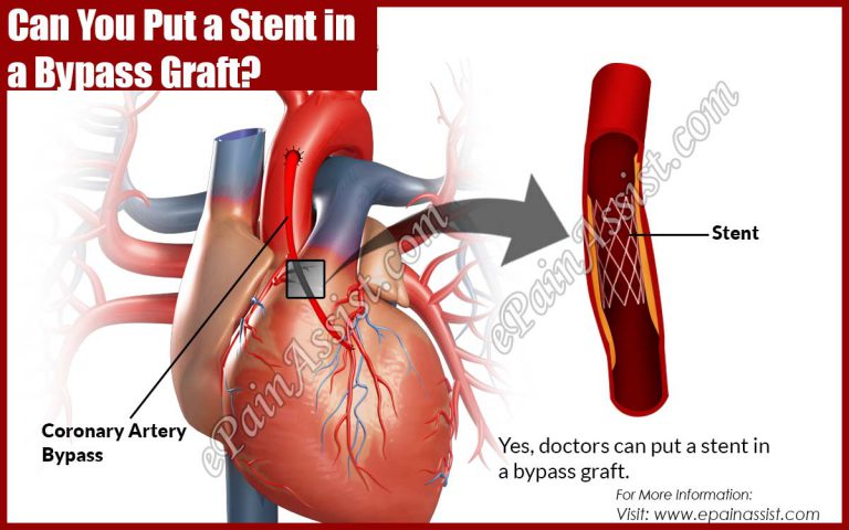Can You Put a Stent in a Bypass Graft?