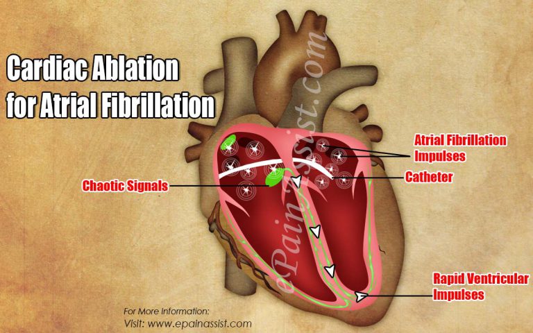Cardiac Ablation for Atrial Fibrillation: Procedure, Benefits, Risks, Recovery