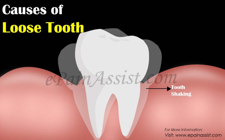 Causes of Loose Tooth & Home Remedies to Save Loose Tooth from Falling Out