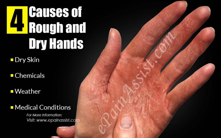 4 Causes of Rough and Dry Hands & Its 6 Home Remedies
