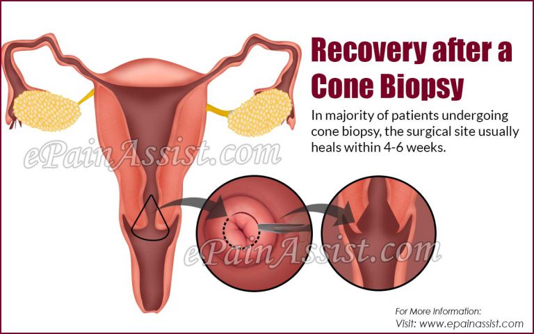 When is it Safe to Start Exercising After a Cone Biopsy?