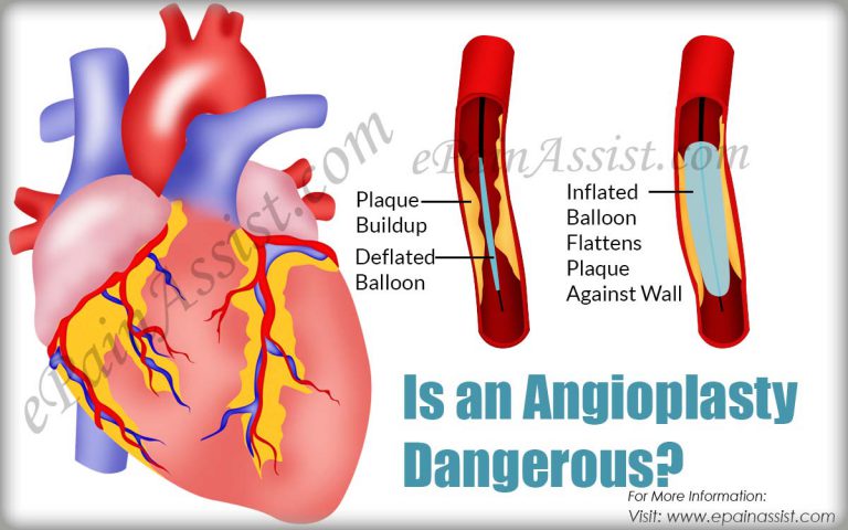 Is Angioplasty Dangerous? Know the Benefits & Risks of Angioplasty
