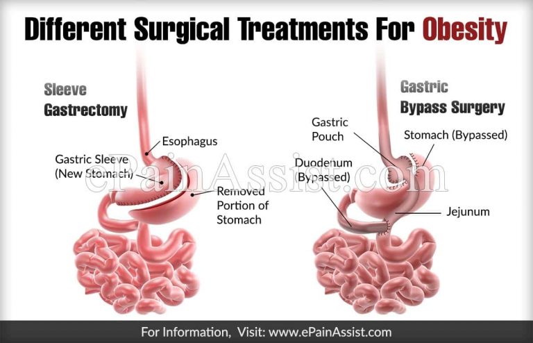 Different Surgical Treatments For Obesity