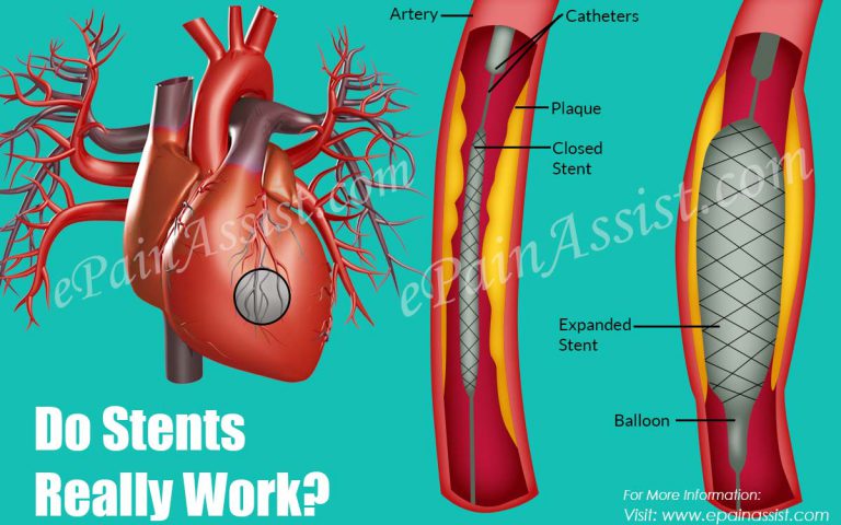 Do Stents Really Work?