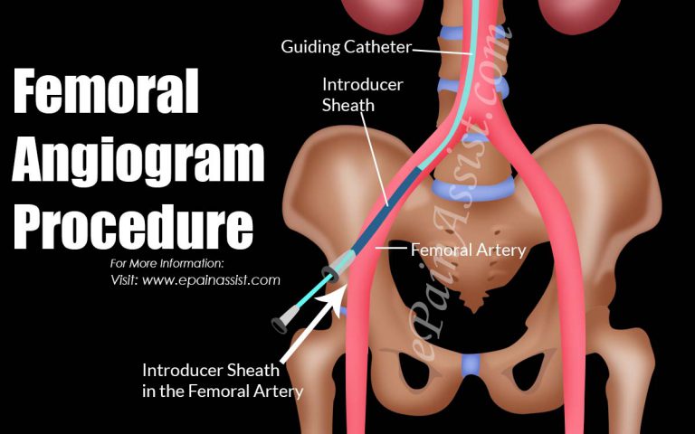 Femoral Angiogram Procedure & Its Complications