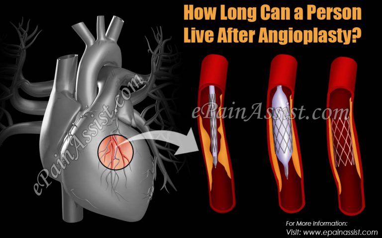How Long Can a Person Live After Angioplasty?