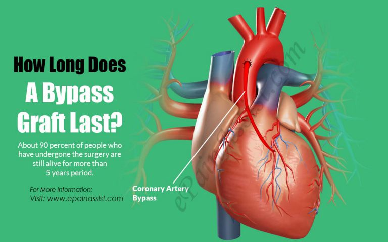 How Long Does A Bypass Graft Last?