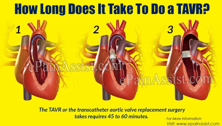 How Long Does It Take To Do a TAVR?