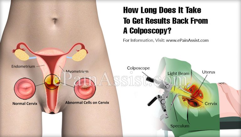 How Long Does It Take To Get Results Back From A Colposcopy?
