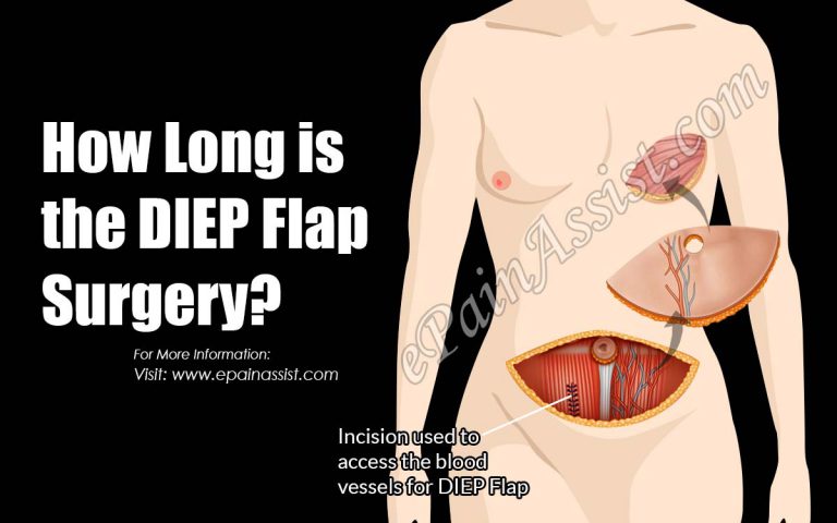 How Long is the DIEP Flap Surgery?