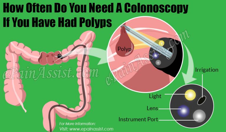 How Often Do You Need A Colonoscopy If You Have Had Polyps?