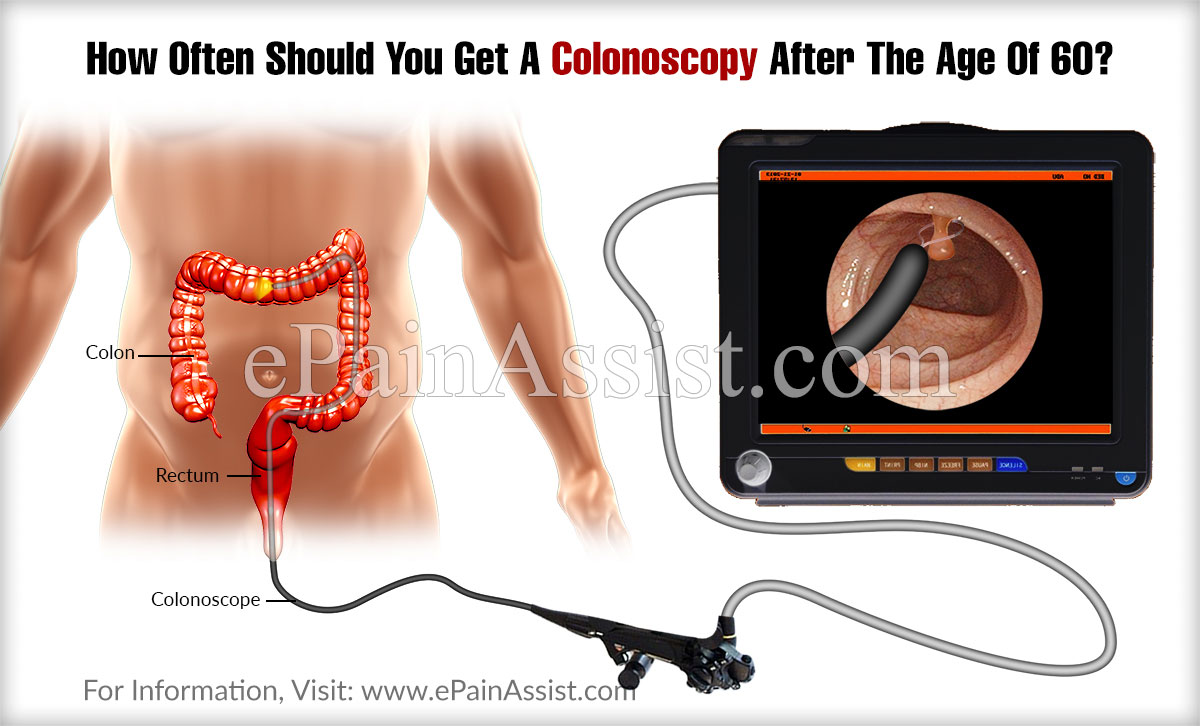 How Often Should You Get A Colonoscopy After The Age Of 60?