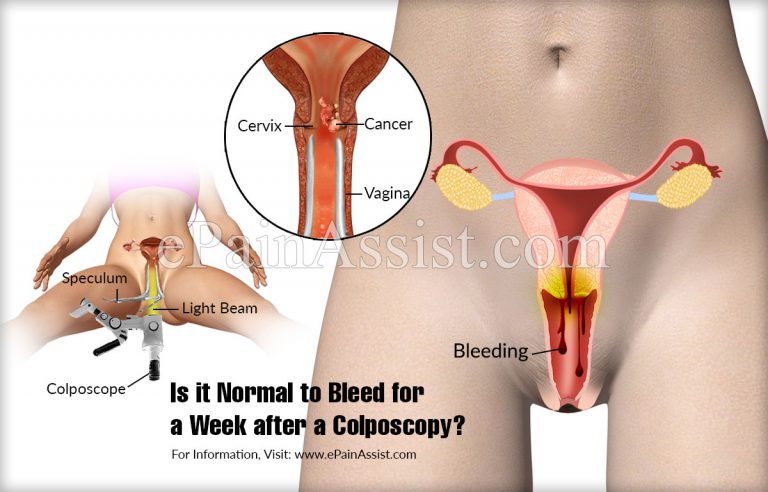 Is it Normal to Bleed for a Week after a Colposcopy?