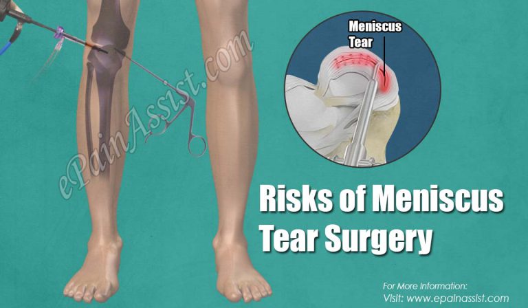 Risks of Meniscus Tear Surgery & the Recovery Period Following Meniscus Tear Surgery