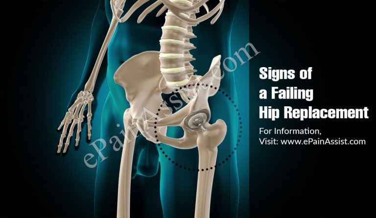 Signs of a Failing Hip Replacement