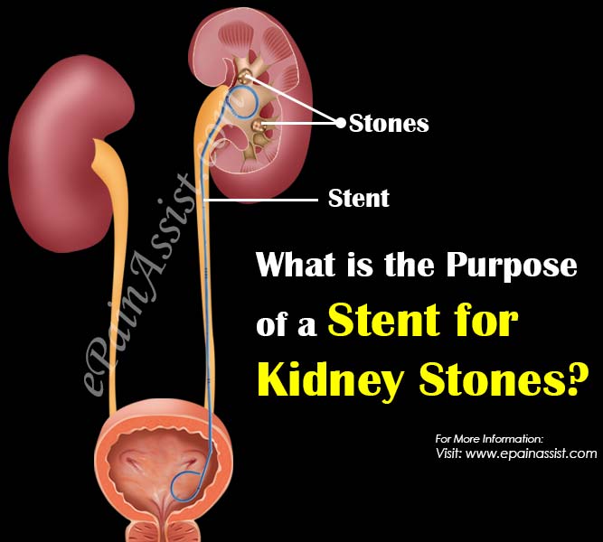 How Long To Leave Kidney Stent In