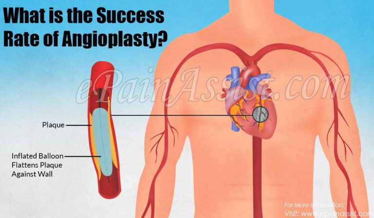 What is the Success Rate of Angioplasty & Can Arteries Reclose After an Angioplasty?