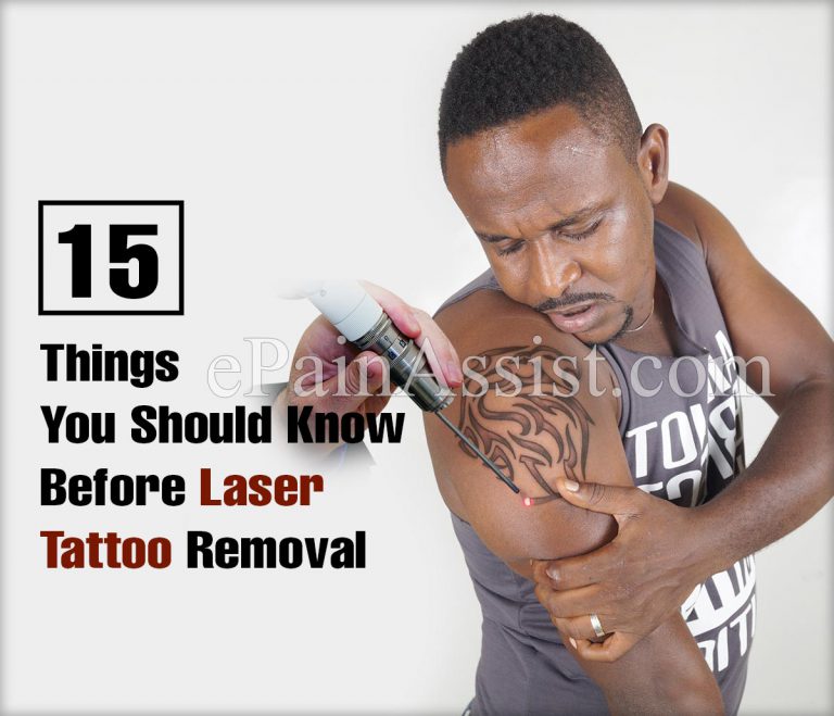 15 Things You Should Know Before Laser Tattoo Removal