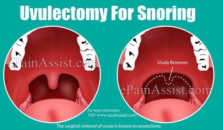 Uvulectomy For Snoring: The Procedure And The Types