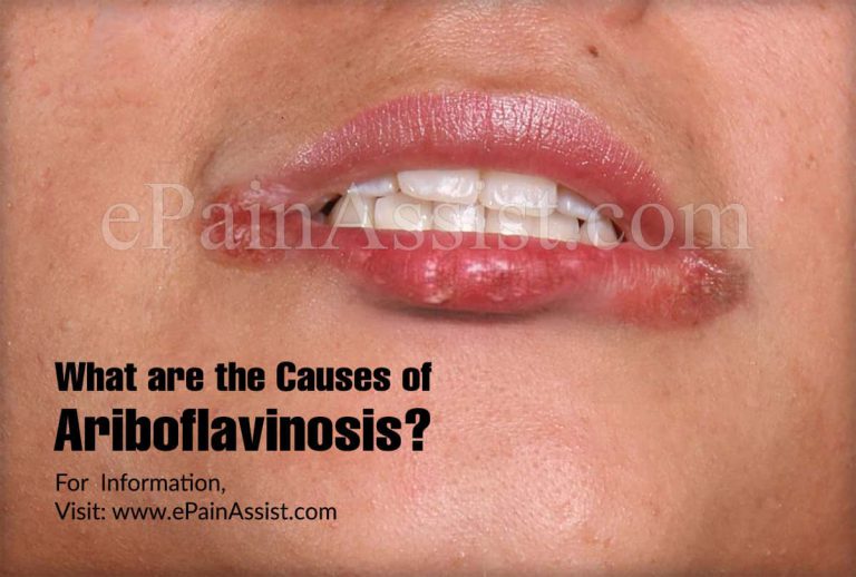 Ariboflavinosis: Causes, Symptoms, Treatments, Risks, Are Vitamin B2 Supplements Needed in Ariboflavinosis