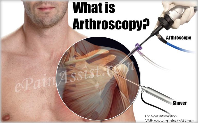 How is Arthroscopy Done & Which Diseases Calls for an Arthroscopy|Recovery Process, Risks, Complications of Arthroscopy