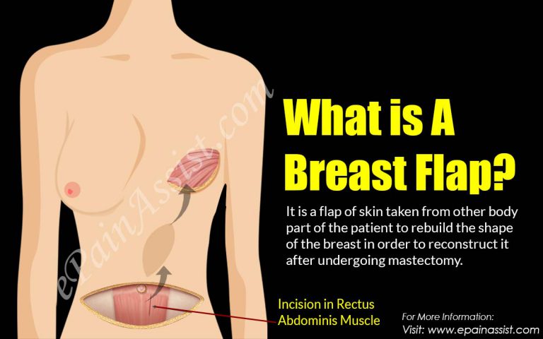 What is A Breast Flap?|How is Breast Flap Surgery Done?|Various Types of Breast Flaps