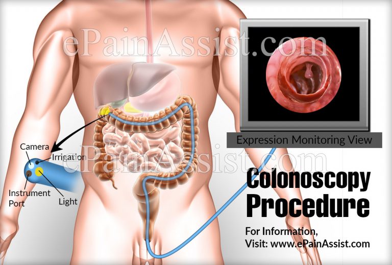 What Is A Colonoscopy Procedure & Why Do You Need To Do It?