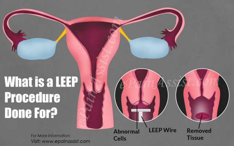 What is a LEEP Procedure Done For?