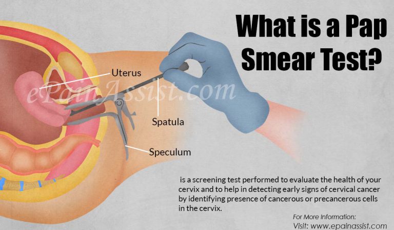 What is a Pap Smear Test and How Is It Done?