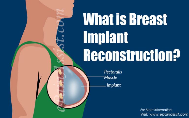 What is Breast Implant Reconstruction?