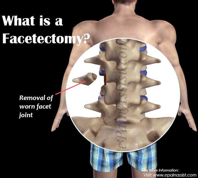 What is a Facetectomy?