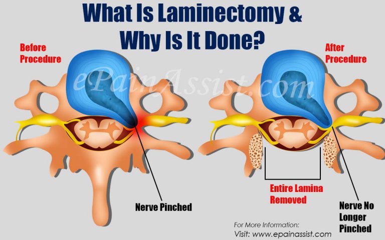 What is Laminectomy and How Dangerous is a Laminectomy Procedure?