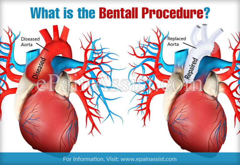 What is the Bentall Procedure?
