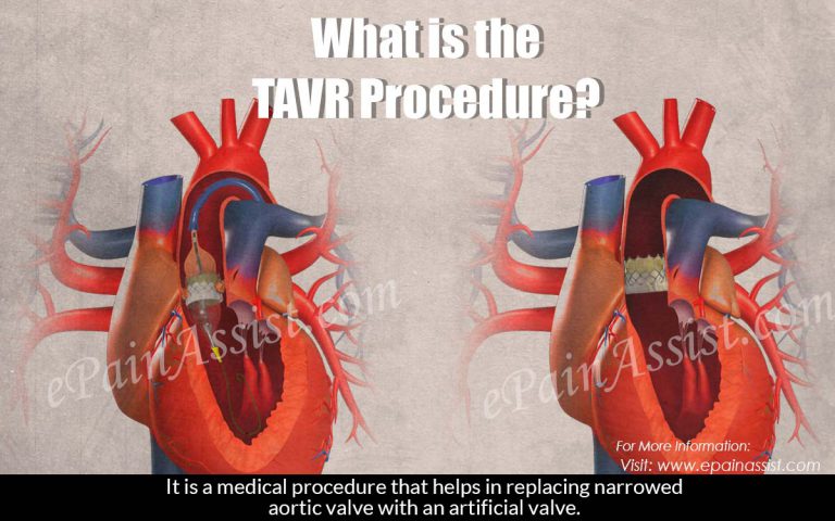 What is the TAVR Procedure?