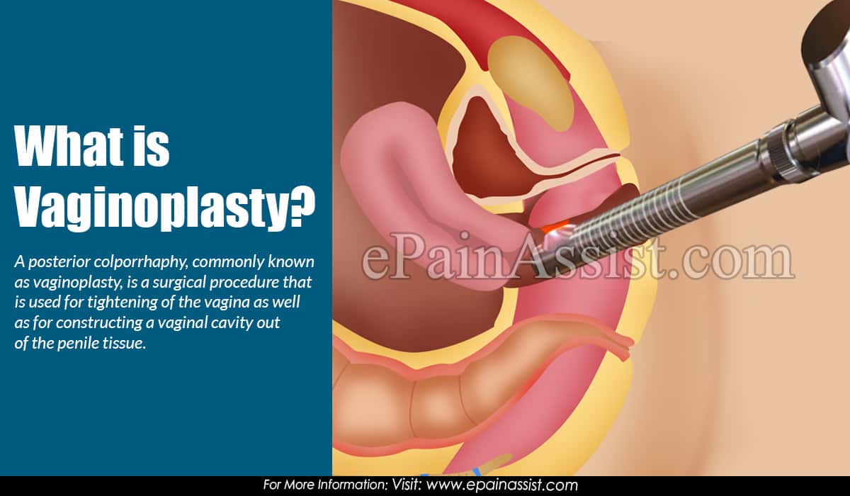 What is Vaginoplasty?